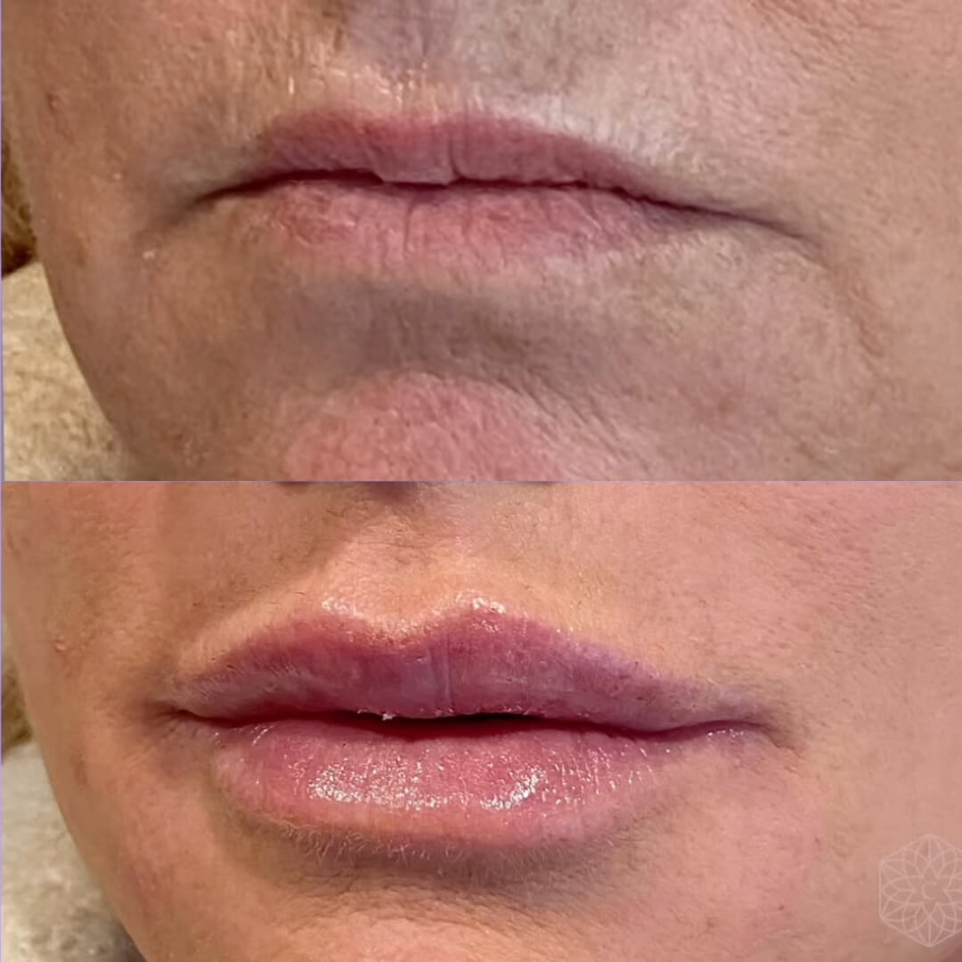 Lip enhancement by Clarity Medical Aesthetics using lip fillers