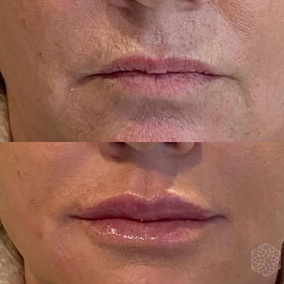 Lip enhancement by Clarity Medical Aesthetics using lip fillers