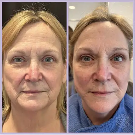 Screenshot 2025-08-13 at 114357 AM Kati Midgley, PA-C, shows her patient before and after her patented Deep Plane Tulip Vector™ PDO Thread Lift, featuring an innovative duo needle technique that results in longer results and higher patient satisfaction.