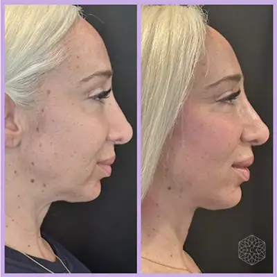 Screenshot 2025-08-13 at 114418 AM Kati Midgley, PA-C, shows her patient before and after her patented Deep Plane Tulip Vector™ PDO Thread Lift, featuring an innovative duo needle technique that results in longer results and higher patient satisfaction.