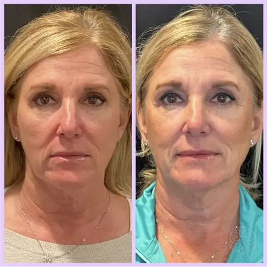 Screenshot 2025-08-13 at 114428 AM Kati Midgley, PA-C, shows her patient before and after her patented Deep Plane Tulip Vector™ PDO Thread Lift, featuring an innovative duo needle technique that results in longer results and higher patient satisfaction.