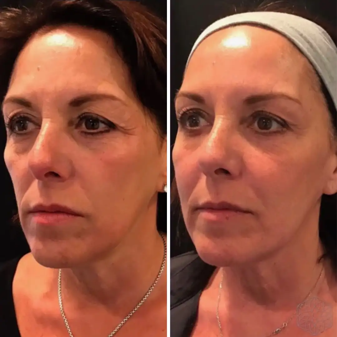 Sculptra before and after patient result at Clarity Medical Aesthetics