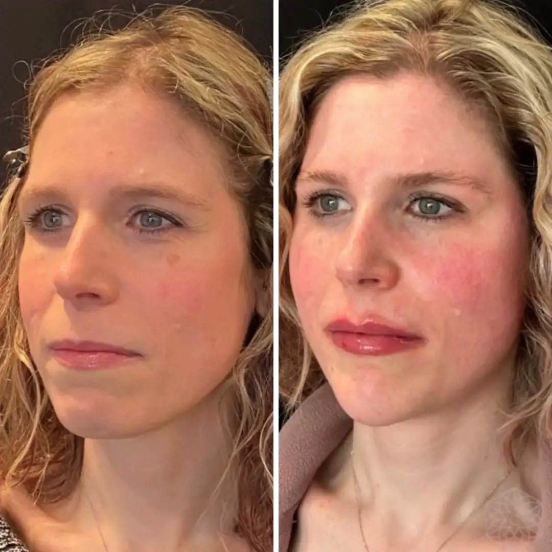 Sculptra before and after patient result at Clarity Medical Aesthetics