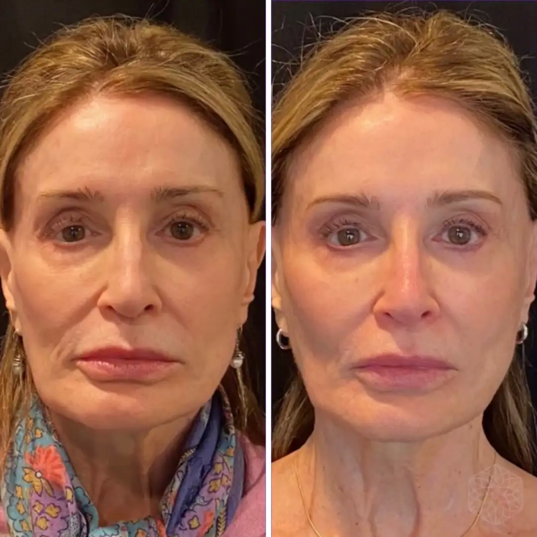 Sculptra before and after patient result at Clarity Medical Aesthetics