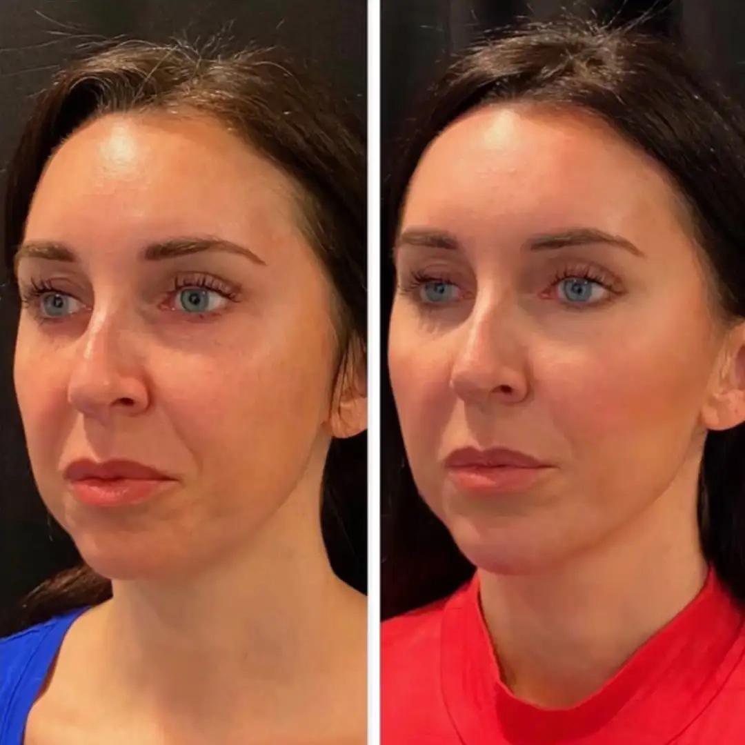 Sculptra before and after patient result at Clarity Medical Aesthetics