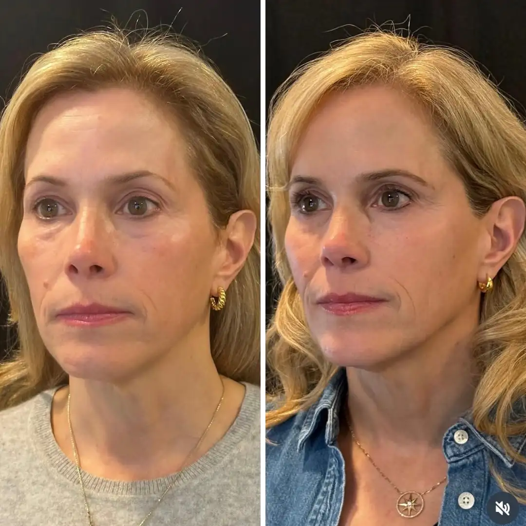 Sculptra before and after patient result at Clarity Medical Aesthetics