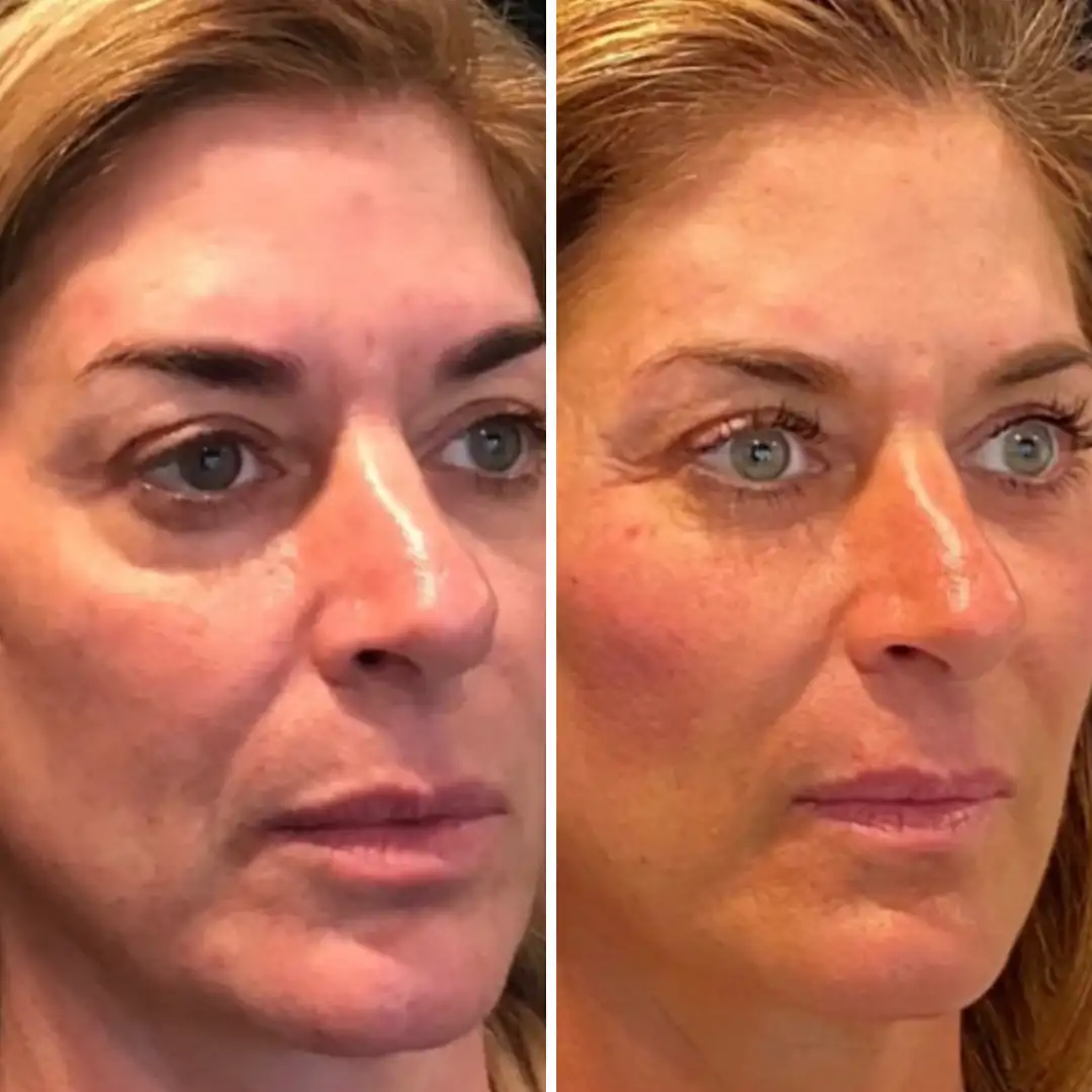Sculptra before and after patient result at Clarity Medical Aesthetics