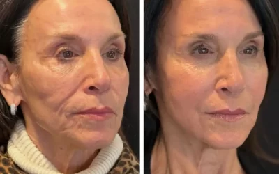 Why Everyone Is Talking About Sculptra Right Now