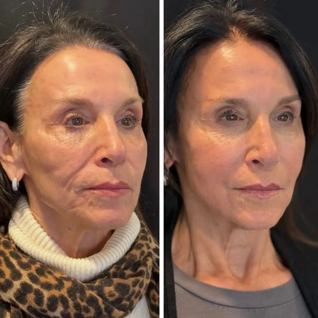 Sculptra before and after result at Clarity Medical Aesthetics